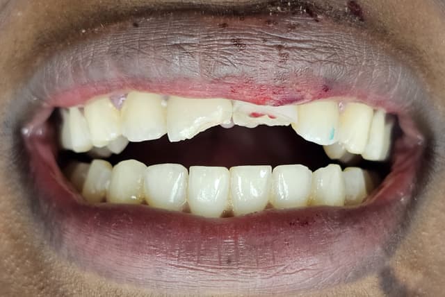 dental abscess treatment birmingham