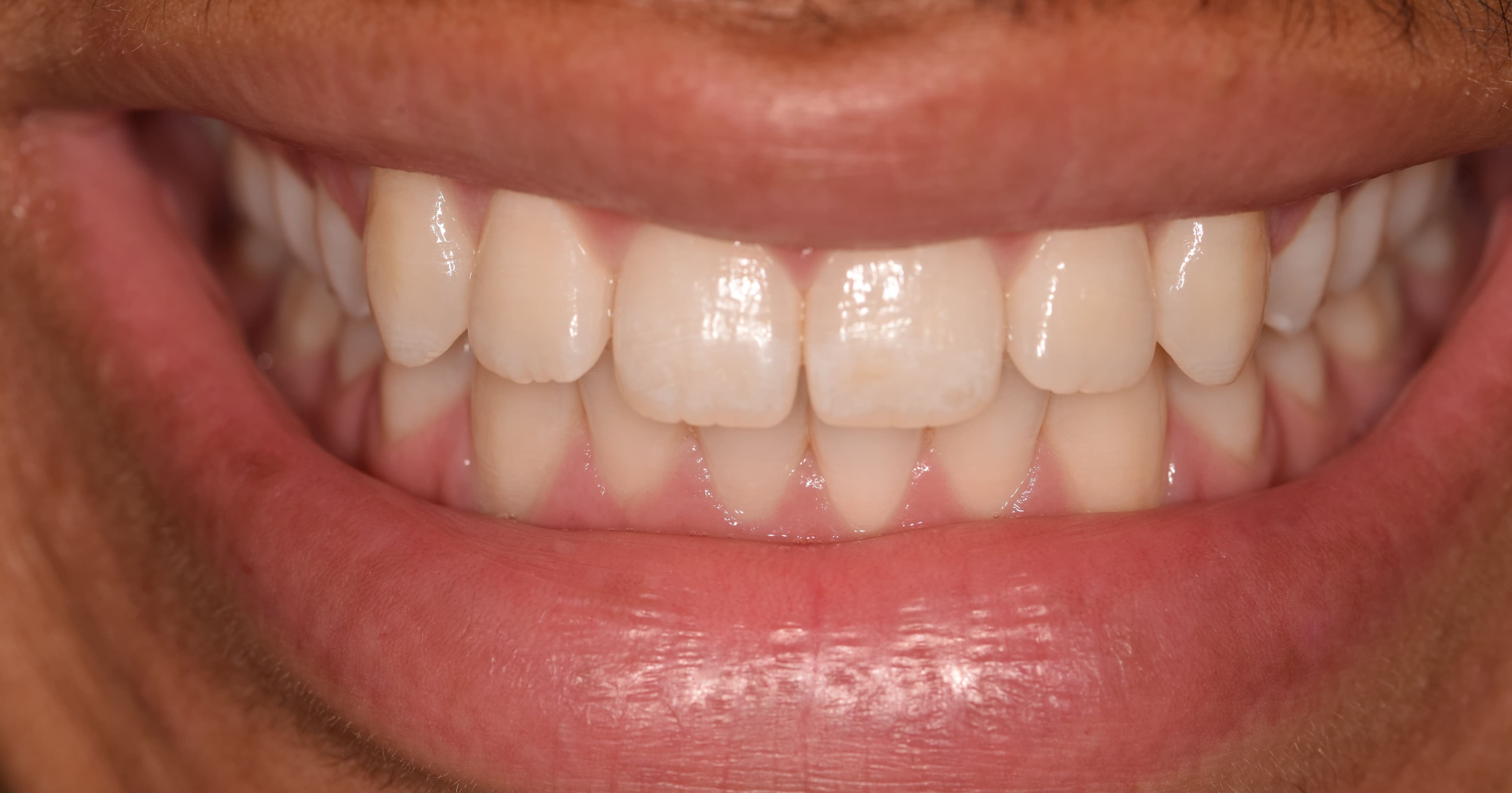 Before and After Porcelain Veneers Smile Restoration